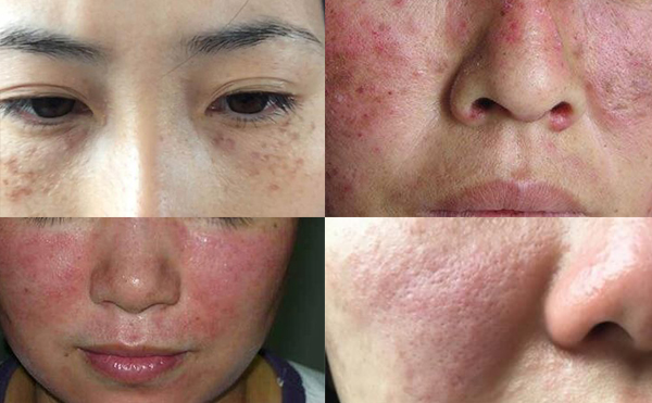 激光脫毛有風(fēng)險(xiǎn)嗎？