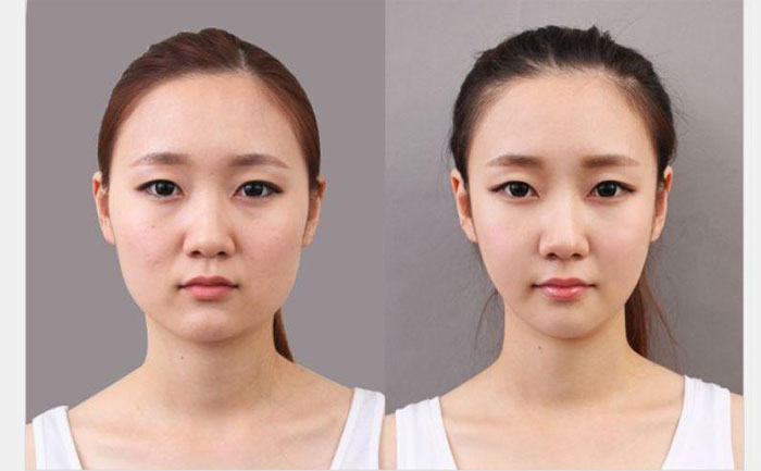 非手術(shù)瘦臉多少錢？非手術(shù)瘦臉方法有哪些？