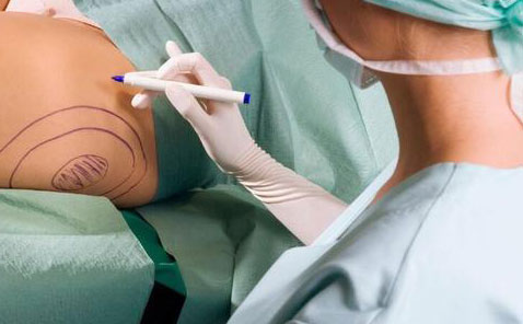 無(wú)痛吸脂是怎么做的？無(wú)痛吸脂手術(shù)價(jià)格是多少？