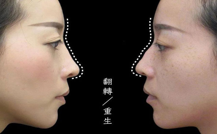 駝峰鼻矯正手術(shù)多少錢？駝峰鼻怎么改善？