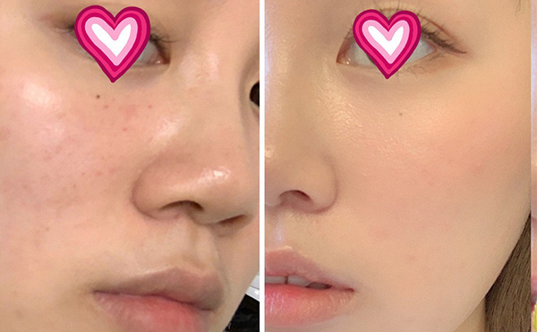 水光針多少錢?價格受哪些因素影響?