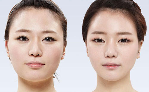 顴骨整形要多少錢？