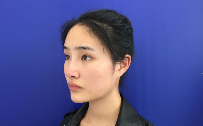 墊下巴一般多少錢？