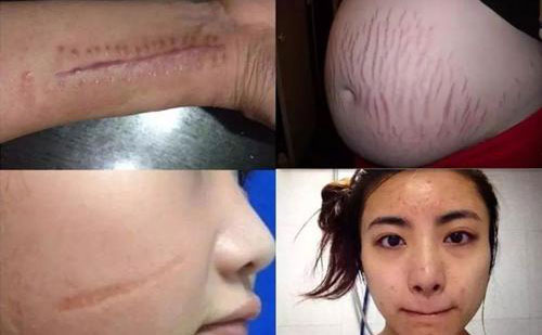 疤痕修復手術一般多少錢？