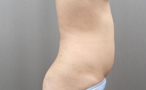 腹部吸脂手術(shù)價(jià)格是多少？腹部吸脂手術(shù)的副作用？