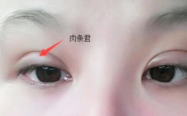 雙眼皮不自然怎么補(bǔ)救？雙眼皮肉條好修復(fù)么？