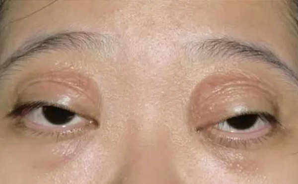 如何區(qū)分腫泡眼和眼球突出?術(shù)前檢查過程?