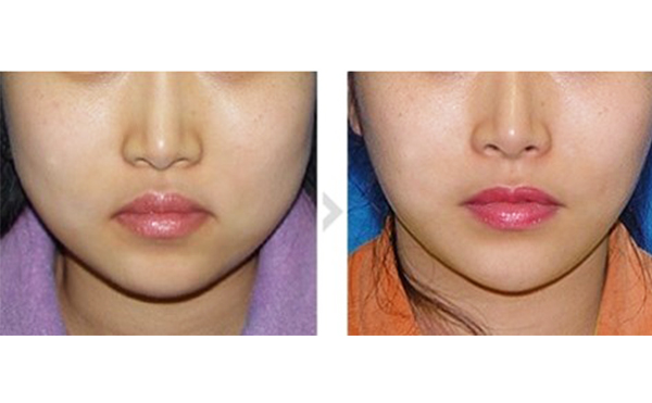 超聲波面部吸脂多少錢？