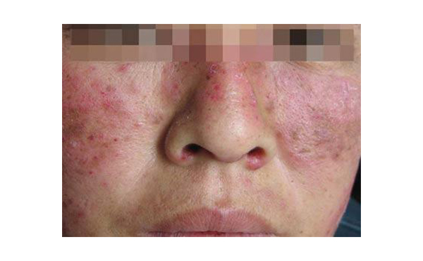 復(fù)合彩光會出現(xiàn)副作用嗎？