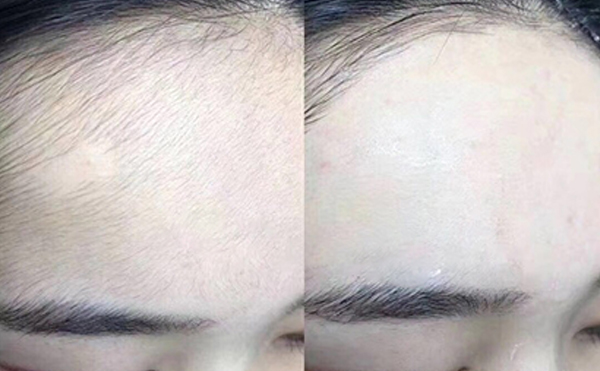 冰點(diǎn)面部脫毛