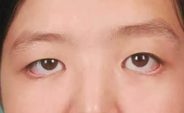 眼袋修復一般多少錢?眼袋修復術(shù)后怎么護理?