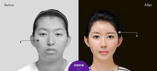 下頜角整形的方法有哪些？