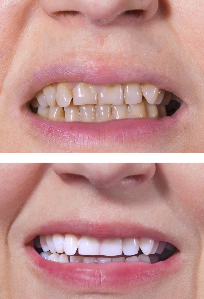 牙齒美白前后效果對比圖