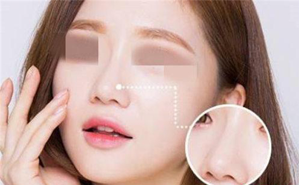 合肥壹加壹整形:出現(xiàn)以下7種情況就是隆鼻失敗了