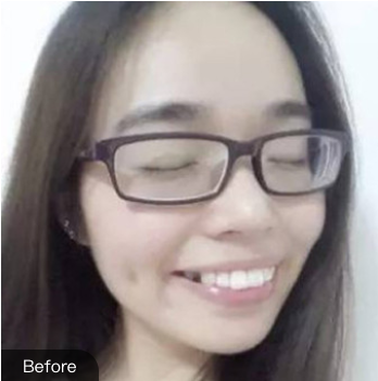 做牙齒矯正之前