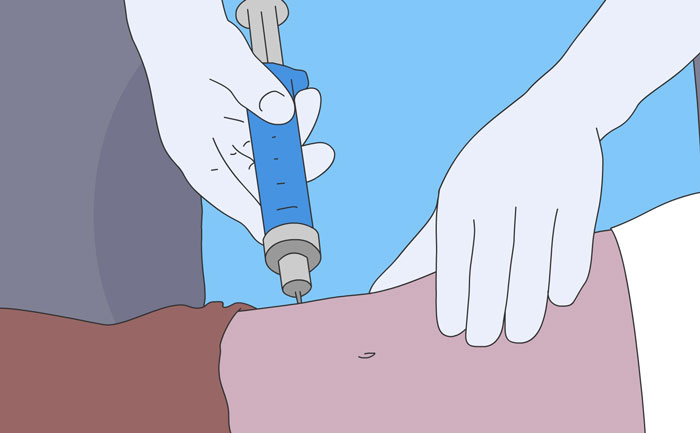 腹部抽脂多少錢?