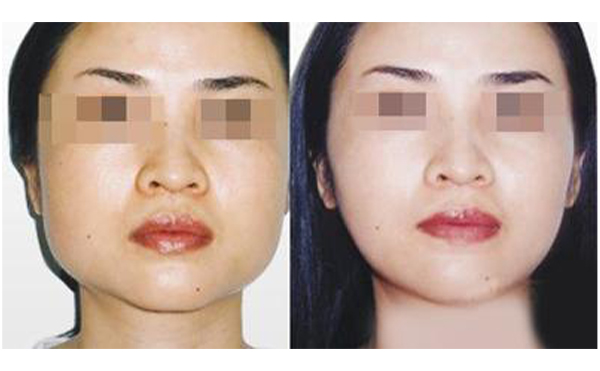 常見的改臉型方法有哪些?顴骨高適合做哪種改臉型手術(shù)?