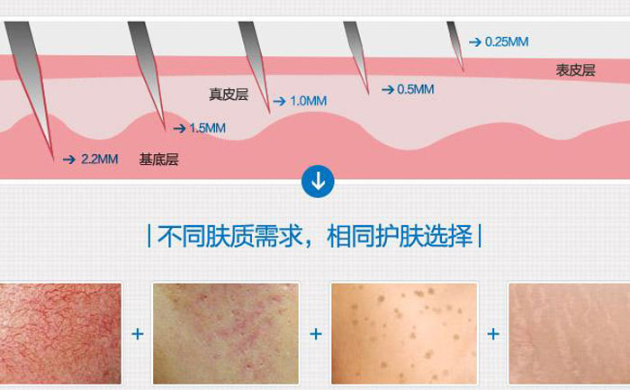 微針去痘坑多少錢一次？
