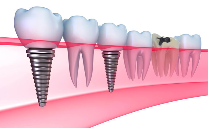 牙齒種植大概費(fèi)用是多少？牙齒種植多少錢一顆