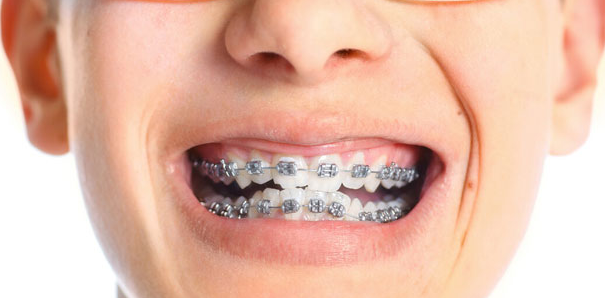 牙齒矯正的最好方法是什么？