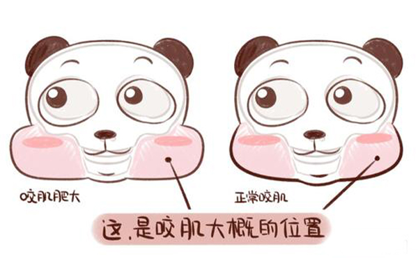 造成咬肌肥大的原因是什么？