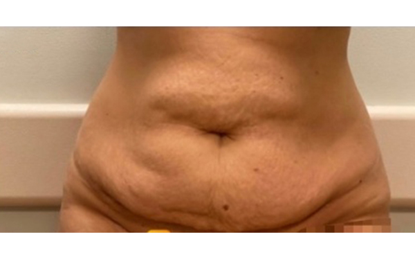 腹壁松弛是什么原因?腹壁松弛怎么辦?