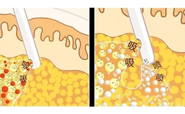 什么是水動力吸脂？