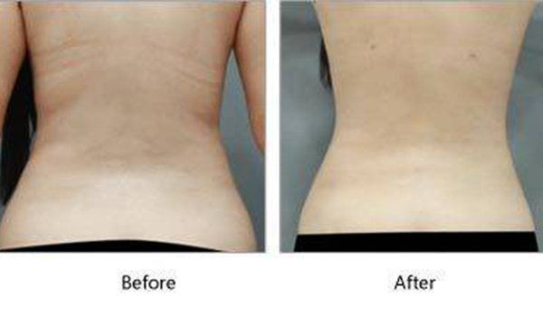 吸脂瘦背部多少錢(qián)？