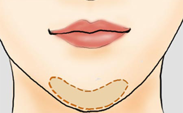一般哪些類型的下巴會(huì)被建議做下巴整形?