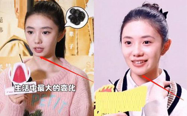 玻尿酸隆下巴整形攻略【優(yōu)勢、適宜人群、注意事項】