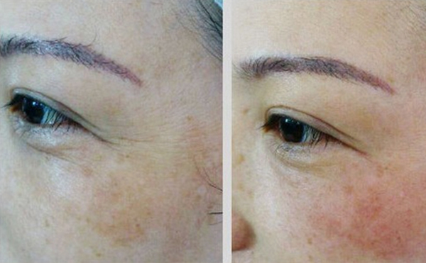 魚尾紋除皺哪些方法好？