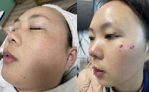 彩光嫩膚有沒有副作用？