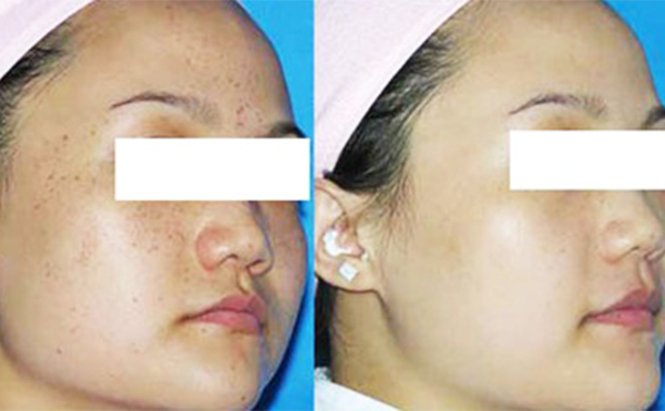 激光祛斑治療一次要多久?