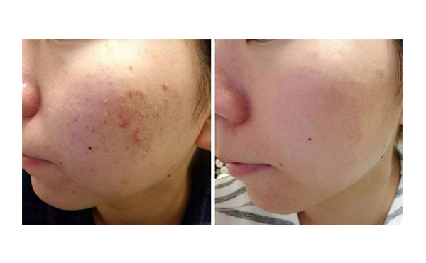 白瓷娃娃的治療過(guò)程是什么？