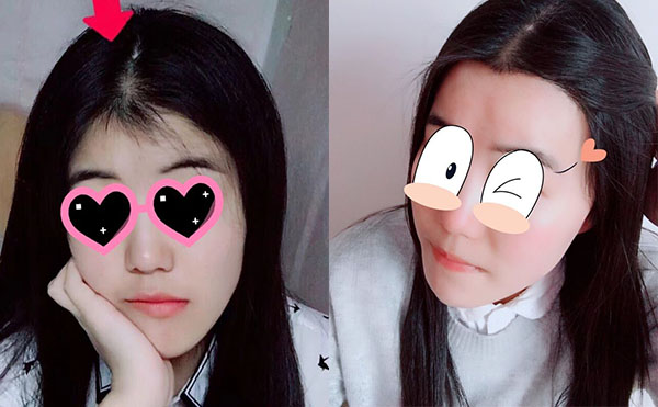 冰點(diǎn)脫毛發(fā)際線怎么樣？