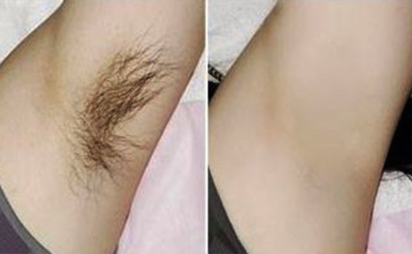 光子脫腋毛有什么優(yōu)勢(shì)？