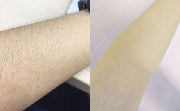 手臂脫毛的方法有哪些?