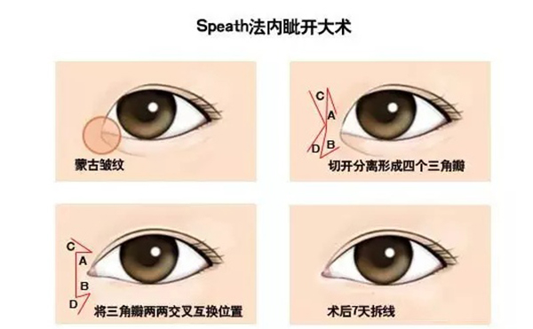 開(kāi)內(nèi)眼角復(fù)雜嗎?手術(shù)過(guò)程是什么?