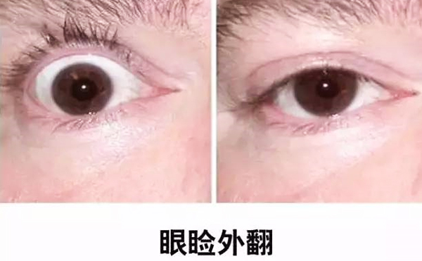 醫(yī)美技術(shù)越來(lái)越發(fā)達(dá)，不少愛(ài)美的人本著變美的心情滿懷期待地去做雙眼皮、開(kāi)眼角等項(xiàng)目，不料整容不成、反倒毀容，后悔也來(lái)不及。有些做雙眼皮的姑娘術(shù)后出現(xiàn)眼瞼外翻的情況，那眼瞼外翻是什么意思?上眼瞼外翻如何修復(fù)?