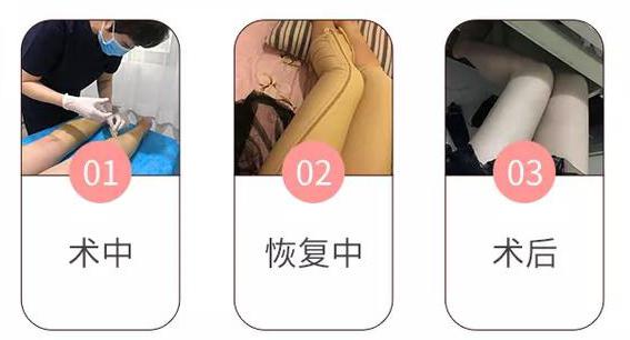 北京華韓：吸脂塑形術(shù)前術(shù)后效果對比圖