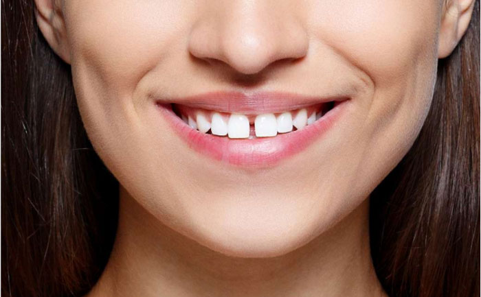 牙縫大可以矯正嗎？