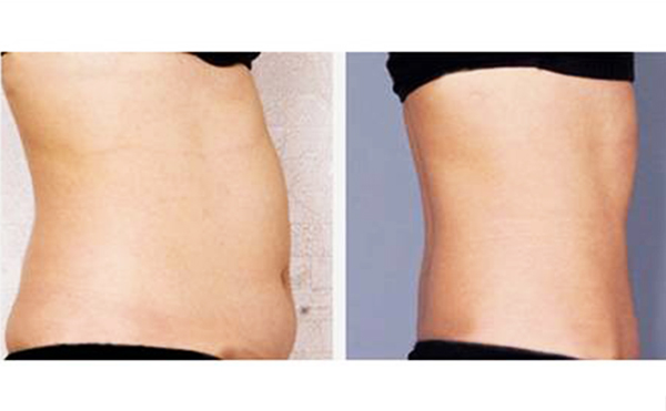 腰腹吸脂安全性高嗎？