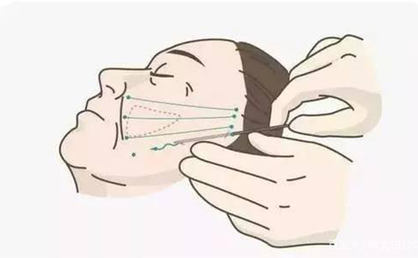 線雕提升好嗎？