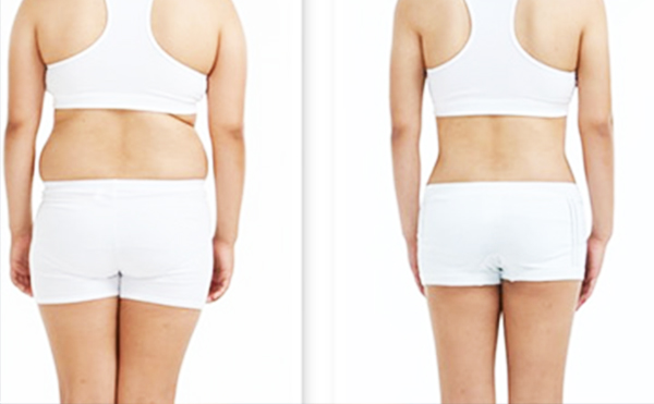 腹部吸脂手術(shù)有哪些常見(jiàn)問(wèn)題？