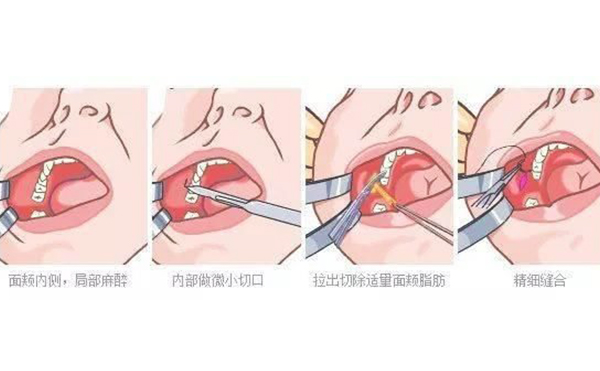 面部吸脂和取頰脂墊有什么區(qū)別?哪個效果好?
