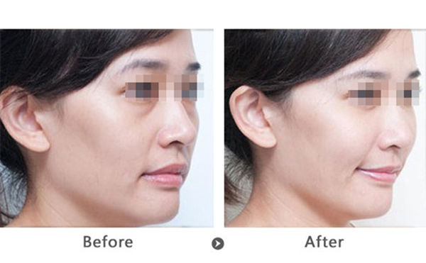 玻尿酸去法令紋多少錢？