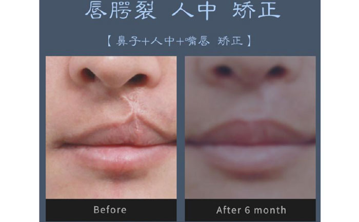 唇裂修復(fù)術(shù)需要多少錢？