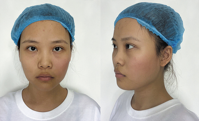 埋線提升案例效果對比圖