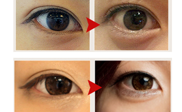 玻尿酸豐臥蠶和自體真皮豐臥蠶有什么區(qū)別?哪個好?