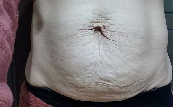 腹壁松弛有哪幾種類型?腹壁成形術哪些人不適合做?